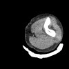SPORK, NICO - 22.03.1976 - 02.08.2022 - CT obere Extremität - 17:56:57